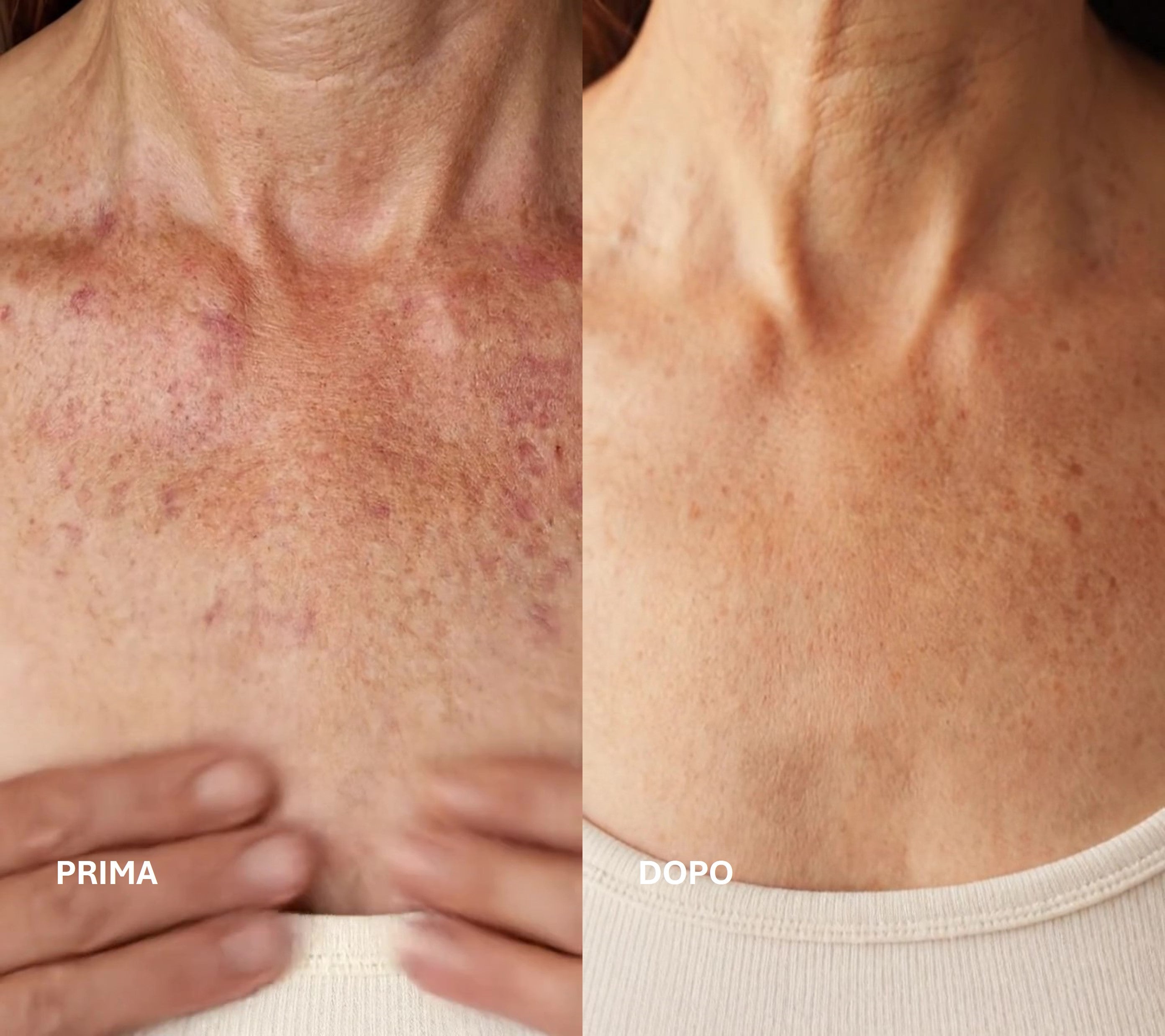 trattapento fototerapia o fotobiomodulazione per macchie sul petto e viso a schiarire, per una pelle bella e morbida.